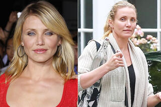 Ces stars ont abusé du Botox !